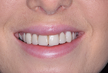 Porcelain Veneers Treatment image 03