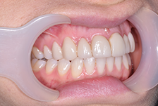 Porcelain Veneers Treatment image 04