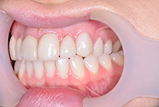 Porcelain Veneers Treatment image 05