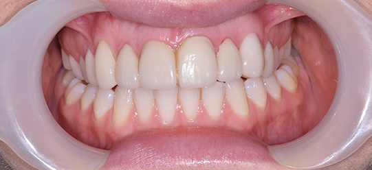 Porcelain Veneers Treatment image 07