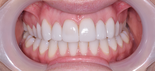 Porcelain Veneers Treatment image 09
