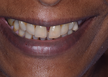 Teeth Whitening and Teeth Bonding Gap Close Treatment Image 01