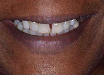Teeth Whitening and Teeth Bonding Gap Close Treatment Image 02