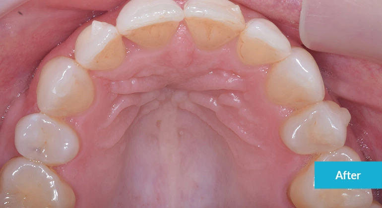 Invisalign Case After