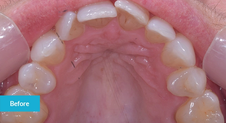 Invisalign Case Before