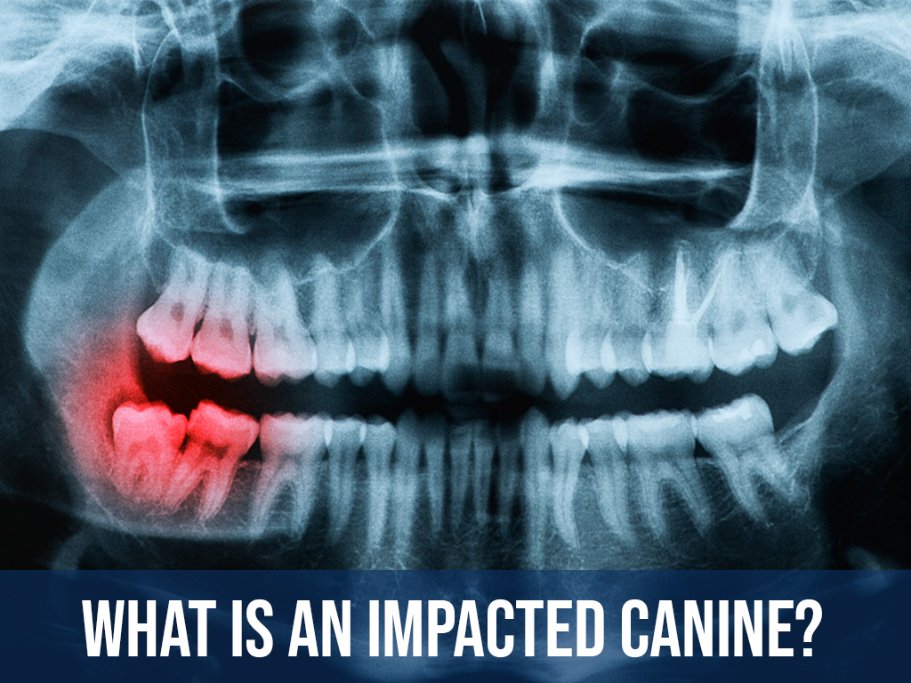 What is an Impacted Canine?