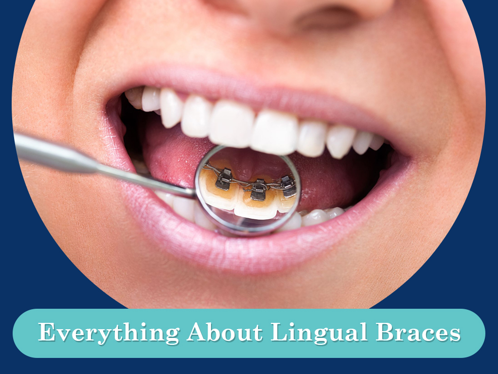 Everything About Lingual Braces