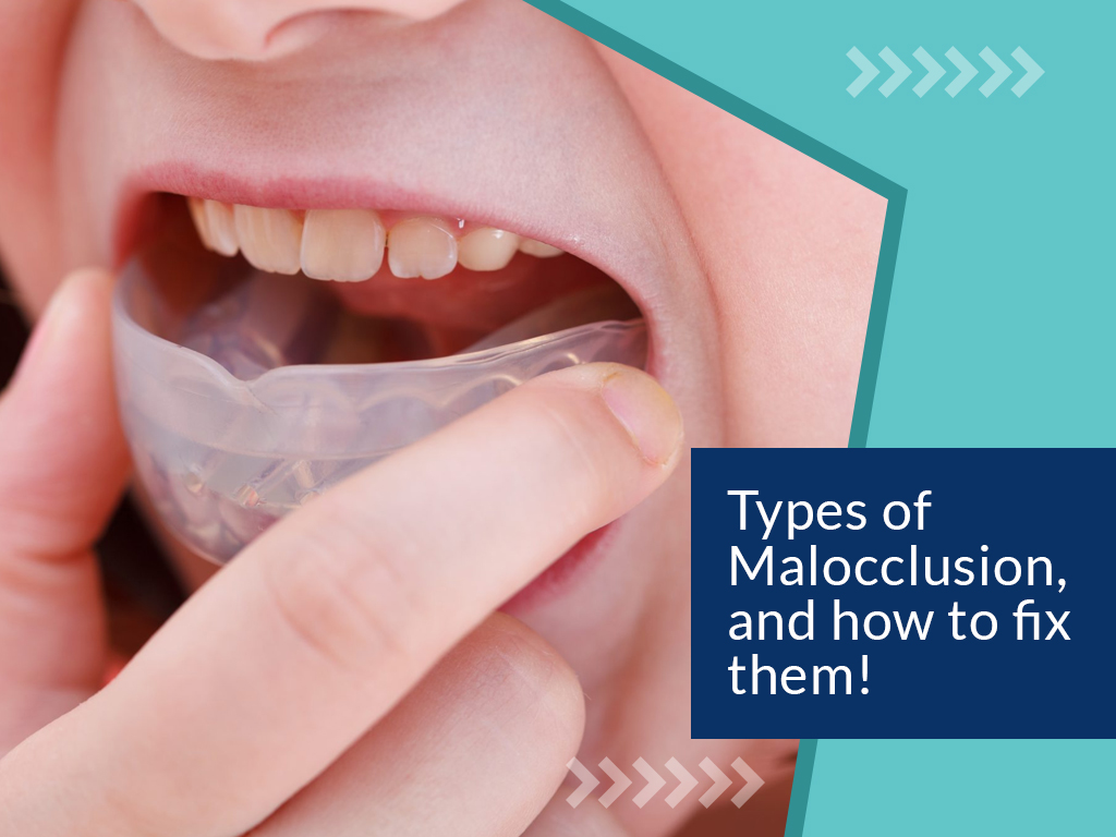 Types of Malocclusion, and How to fix Them!
