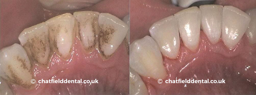 Hygienist Stain Removal