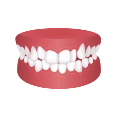 Crowded teeth – Chatfield Dental Braces