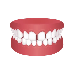 Gapped Teeth – Chatfield Dental Braces
