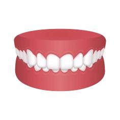 Overbite Teeth – Chatfield Dental Braces