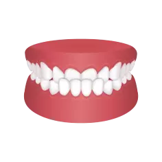 Underbite – Chatfield Dental Braces