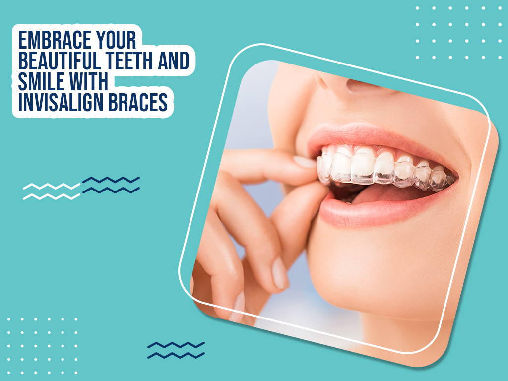 Start using Invisalign Braces from today to Embrace your Beautiful Teeth and Smile