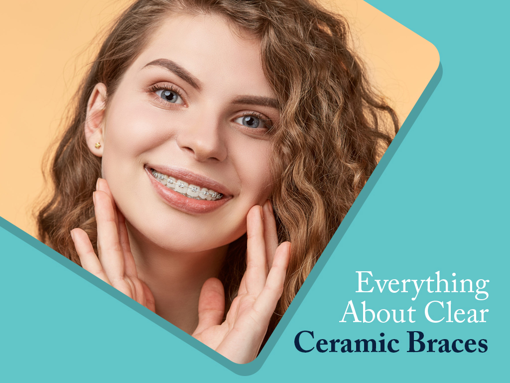 Everything About Clear Ceramic Braces