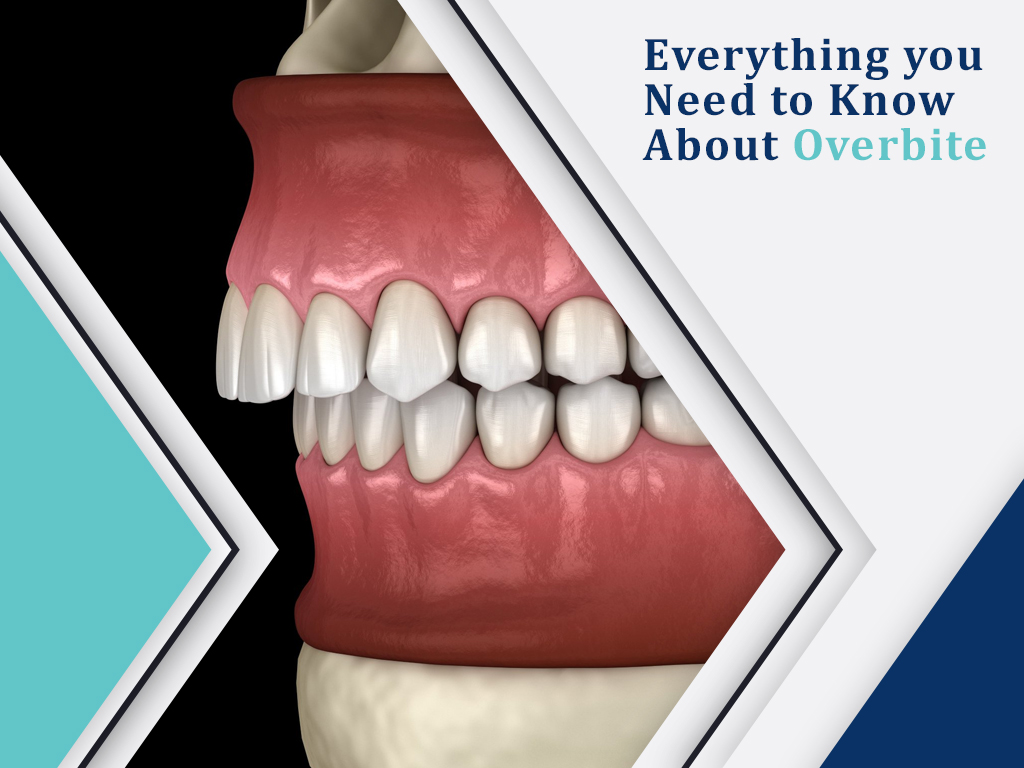 Everything you Need to Know About Overbite