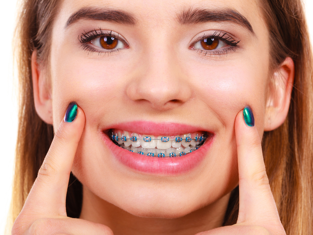 Complete Guide to Six Month Smile Braces Treatment