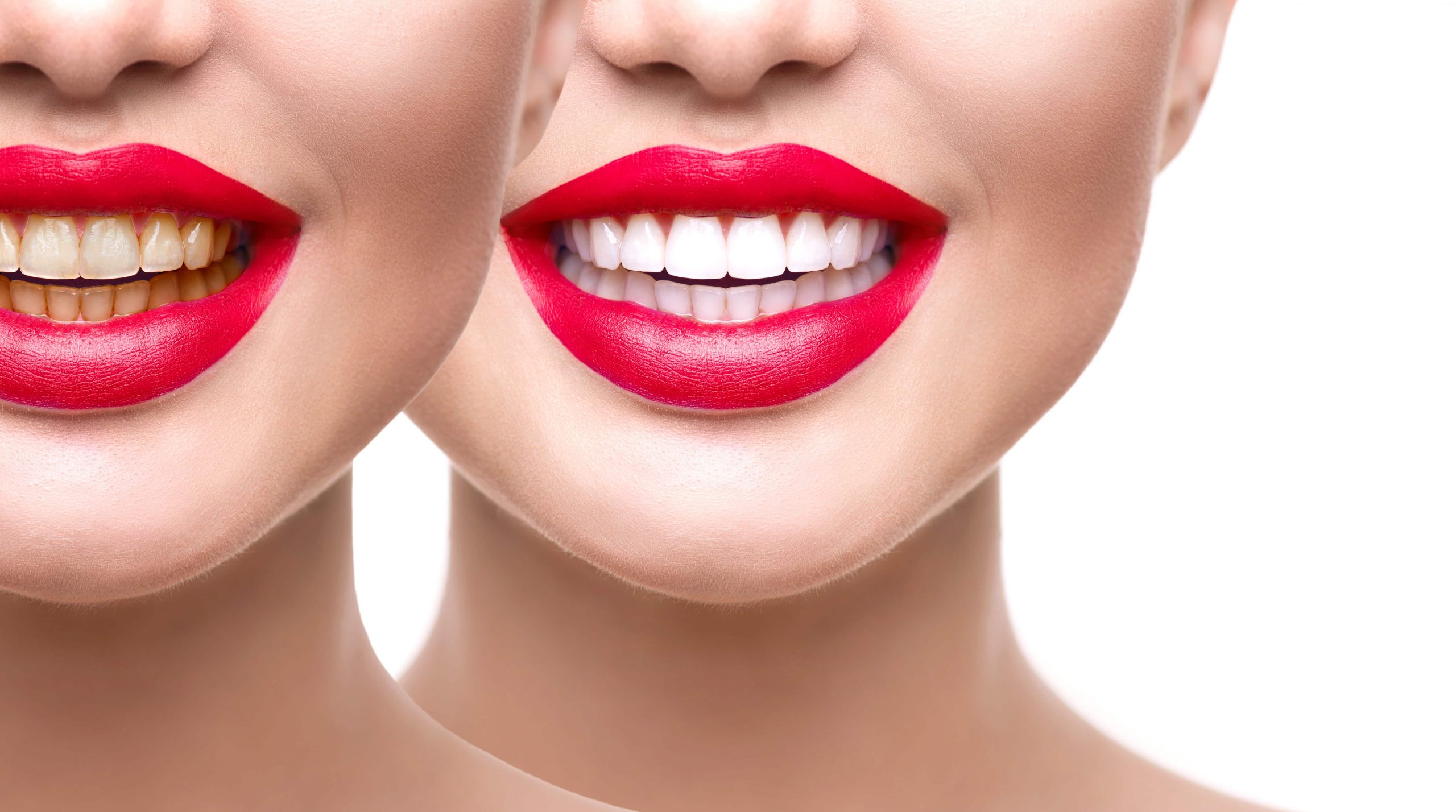 Teeth Whitening – Chatfield Dental Braces